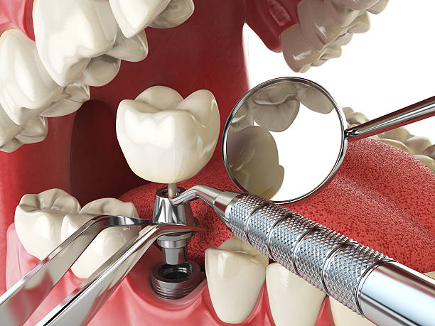 Best Emergency Root Canal Treatment in Desloge, MO